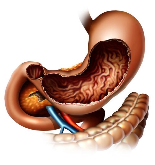 gastrite mucose gastriche pareti dello stomaco